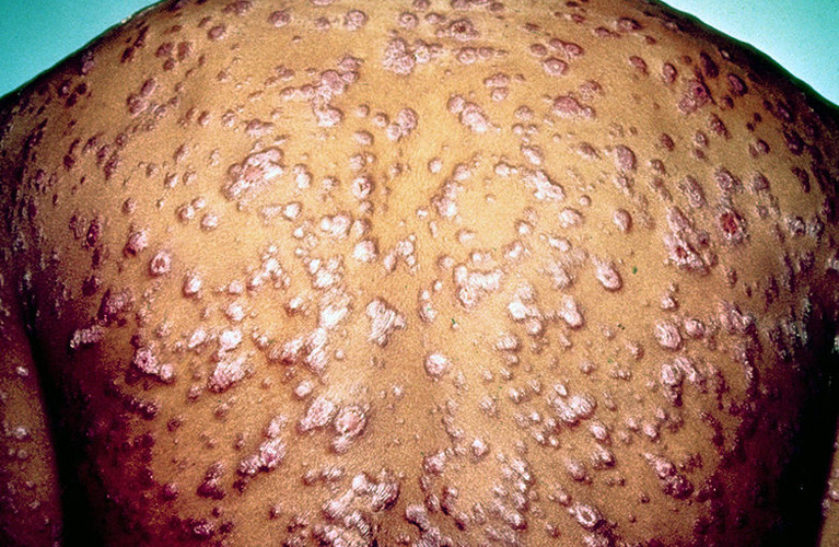 Veneral Diseases Treatment